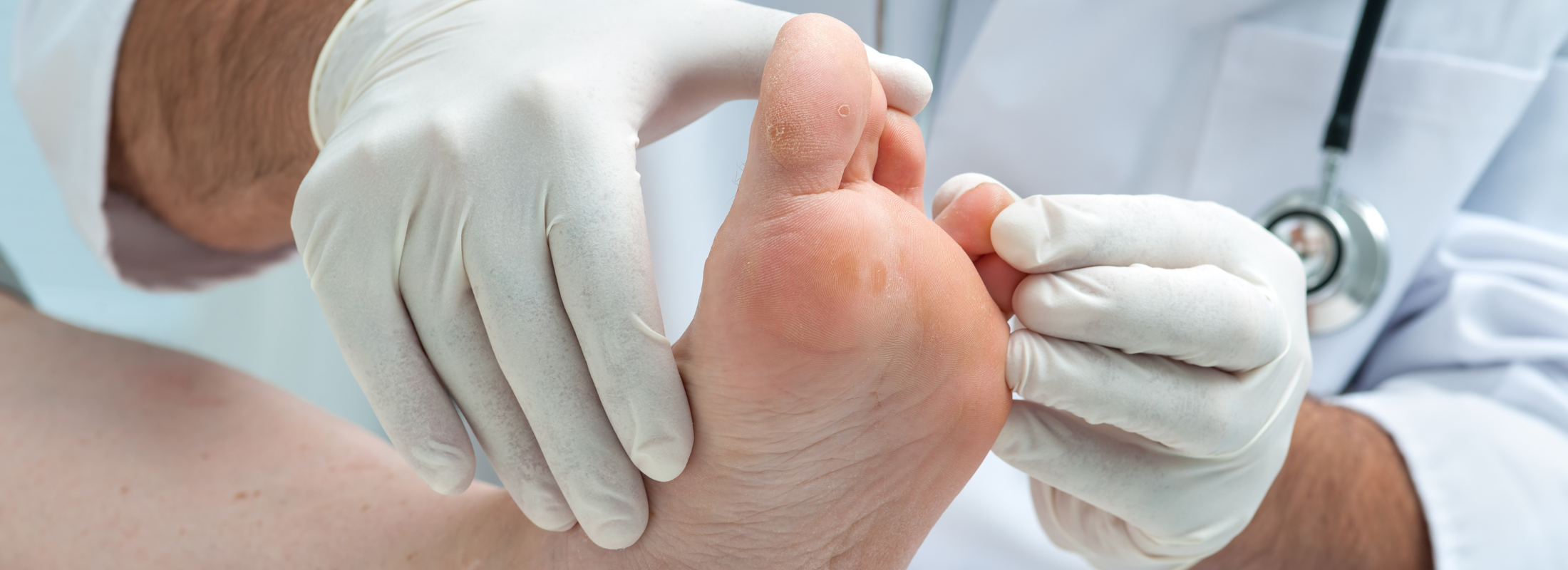 Athlete's Foot - Common Symptoms & Treatment
