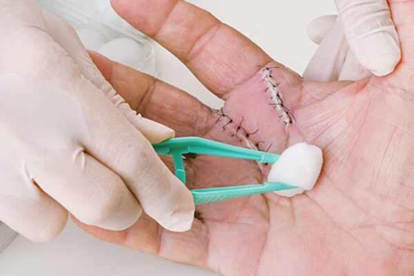 Does Urgent Care Give Stitches?