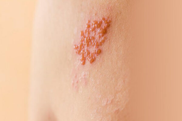 Facts About Shingles: Is Shingles Contagious?