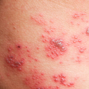 What does shingles look like