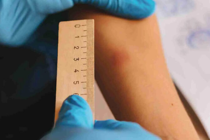 Convenient TB Tuberculosis Testing at Urgent Care